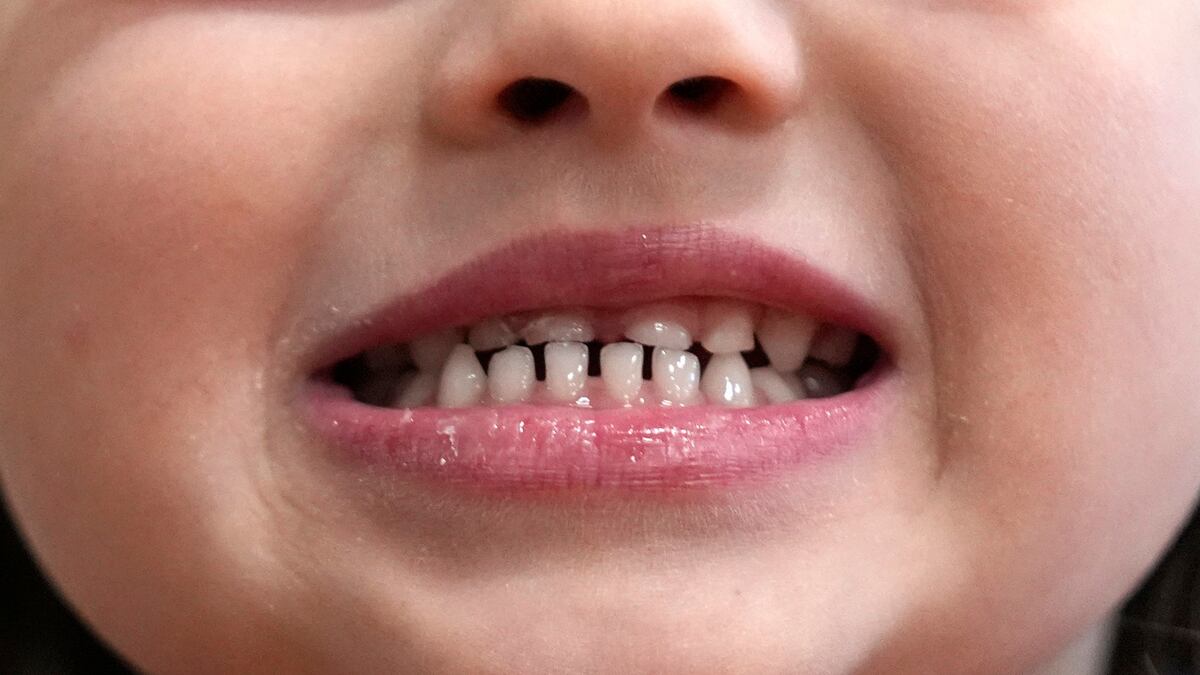 Fluoride Ban In Drinking Water May Lead To Increase In Cavities